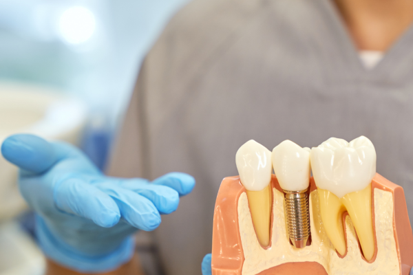 Dental Implant